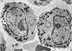 M,80y. | blood - myeloid leukemia M,80y. | blood - myeloid leukemia